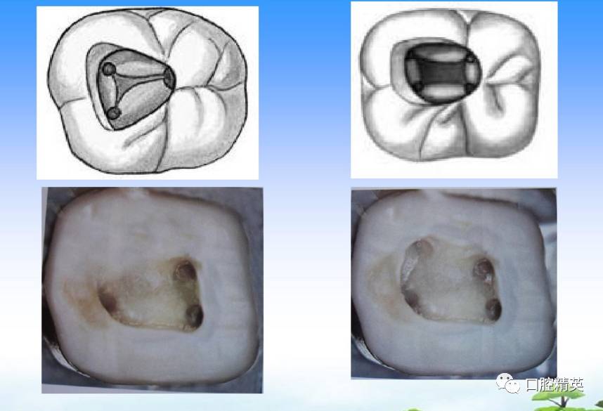 详解各牙位的开髓整理版