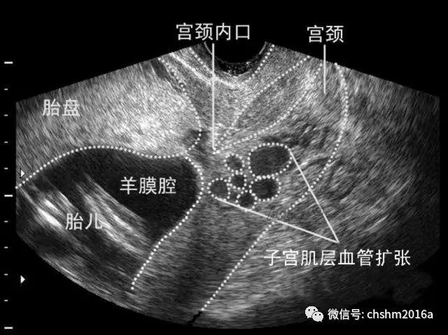 胎盘位置彩超图图片