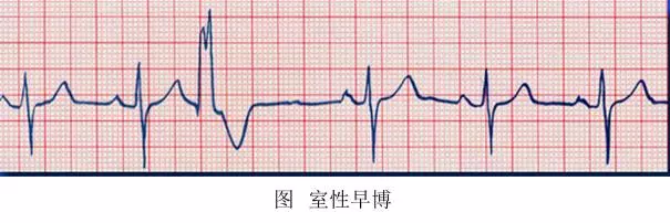 一句话速记心电图