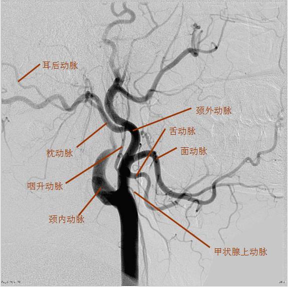 圖5 頸外動脈解剖示意圖頸外動脈自頸總動脈分出後,首先位於頸內動脈