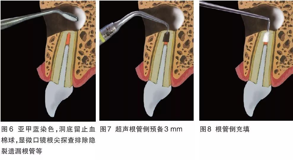 显微根尖手术牙体牙髓保留患牙的最后一步