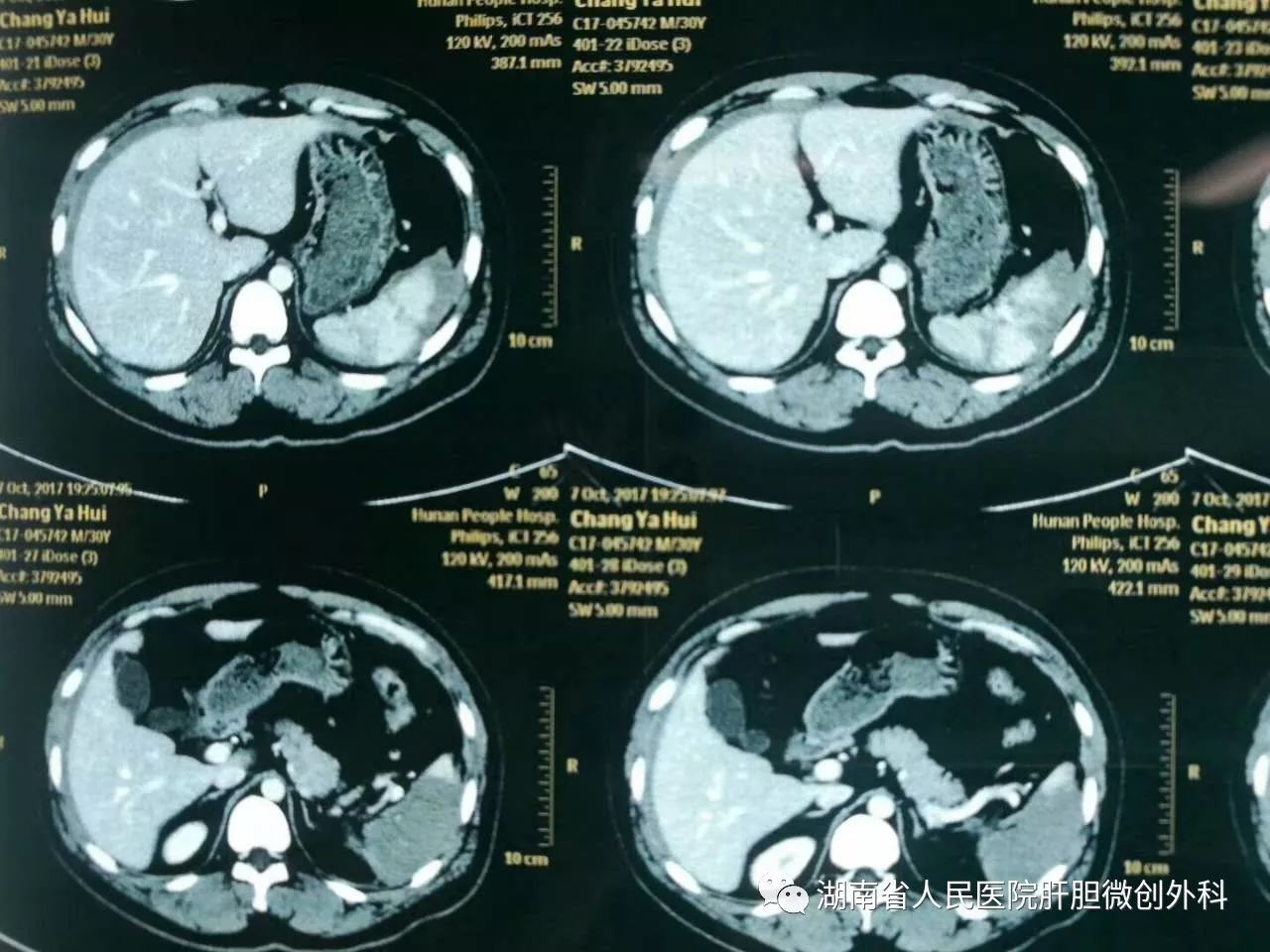 脾破裂ct影像表现图片图片