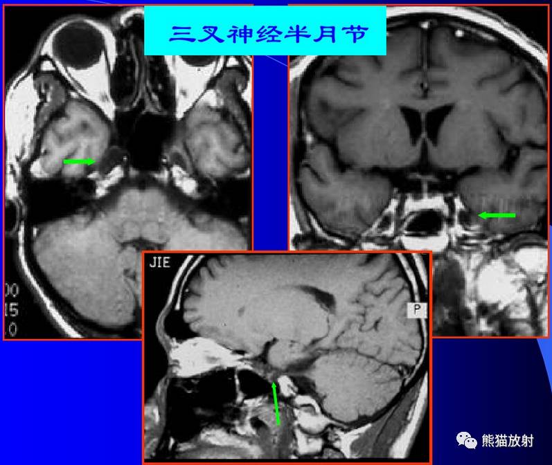 顱神經 mri 斷層解剖【收藏】