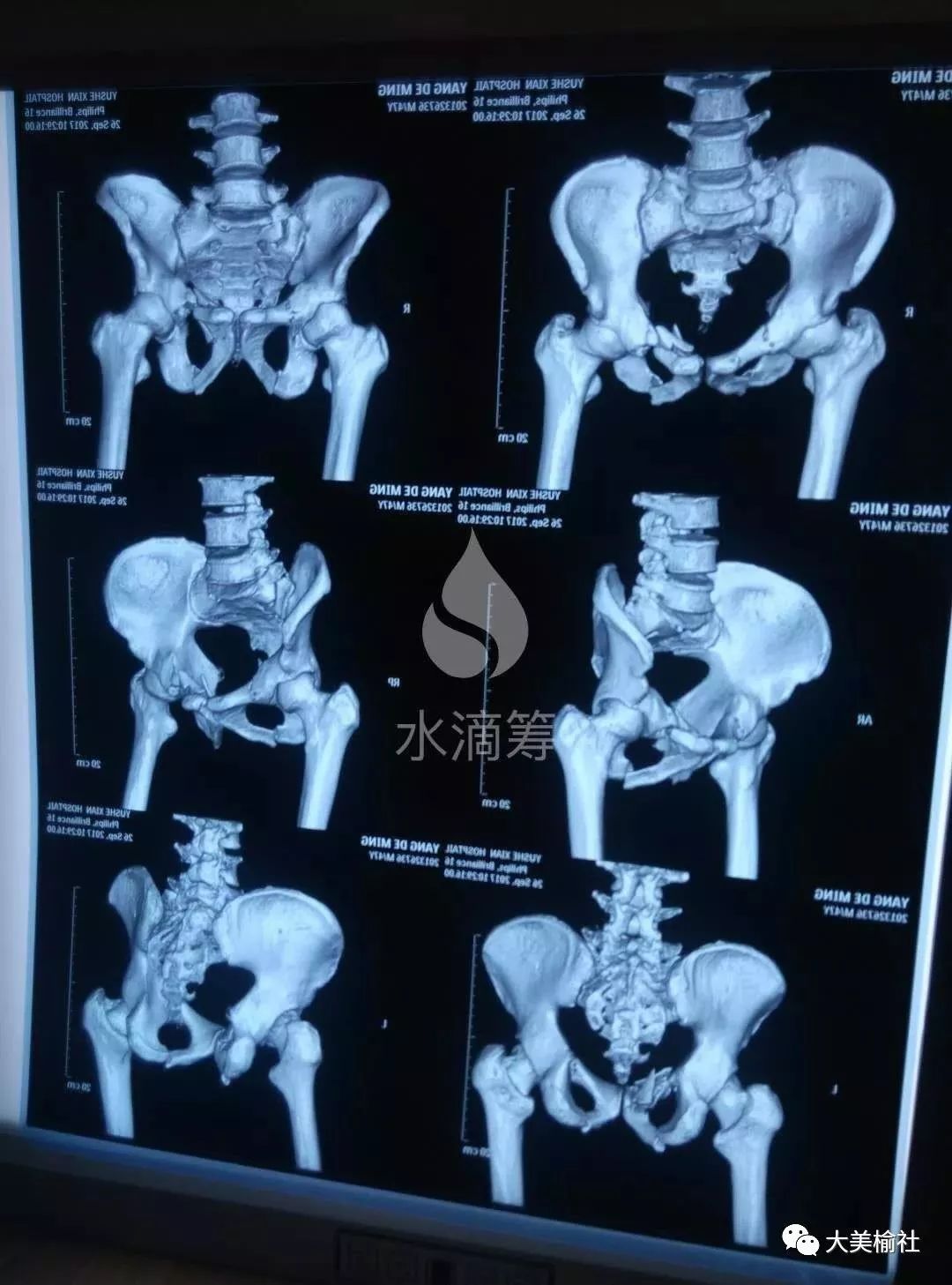 榆社雲竹鎮馬蘭村他全身多處骨折肋骨斷了六根