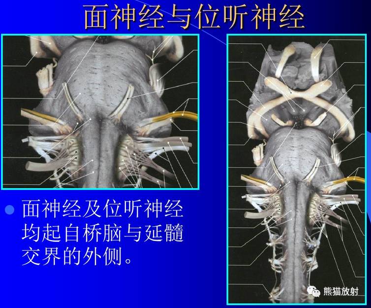 颅神经 mri 断层解剖【收藏】