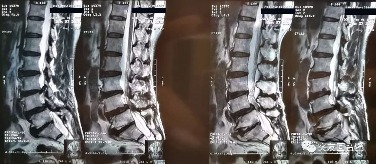 腰椎退行性脊柱病並腰4椎體向前滑脫i度;腰椎骨質增生;腰1/2-腰5/骶1