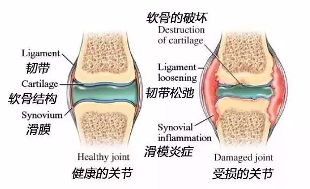 化脓性关节炎图片图片