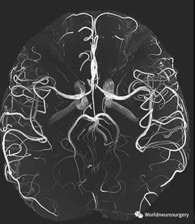 头颅MRA解剖图片