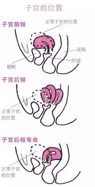 子宫后位手法复位图图片