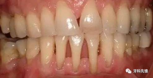 牙龈萎缩示意图误区五得了牙周病,治疗没用要拔牙在牙龈炎还没有发展
