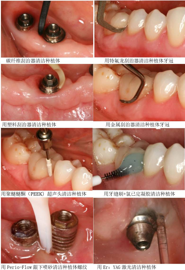 清洁种植体的方法包括刮治器刮治,超声震动,龈下喷砂,激光等等,有研究
