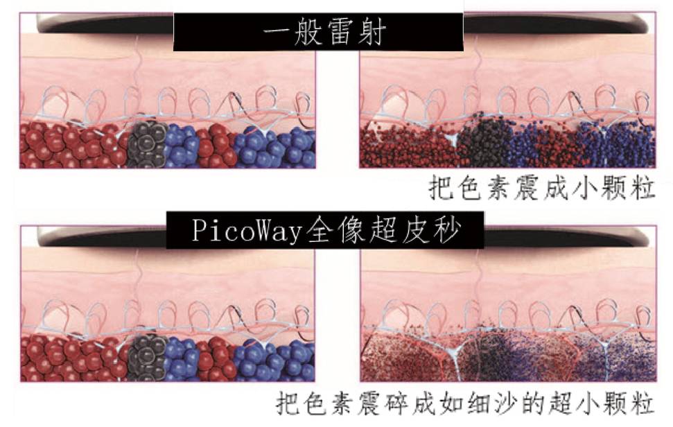 祛斑界的法拉利丨第Ⅱ代超皮秒即将登陆焕誉医美,范爷都为之倾心