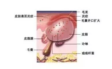 皮膚問題要分清毛囊炎和痤瘡帶你認識毛囊炎