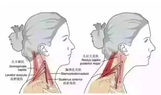 頸椎輕度反弓嚴重是什麼症狀