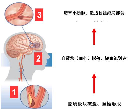 脑梗死发病机制图片