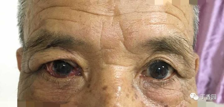2 周后,患者眼表的血管逐渐红润,角膜透明光泽,眼球并没有萎缩和溉揪