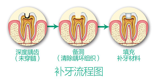 树脂补牙全过程图片图片