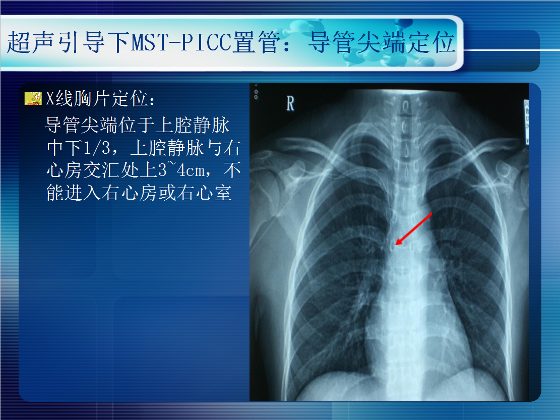 無線超聲引導下picc置管