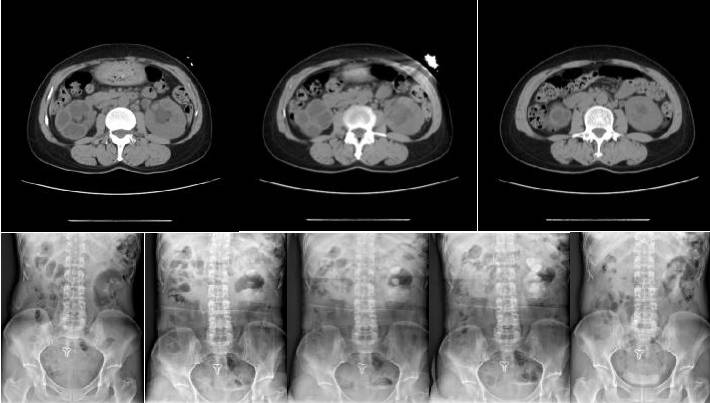 胸片 上腹部ct平掃 靜脈尿路造影(ivp)患者女,51歲,入院前20 天,患者