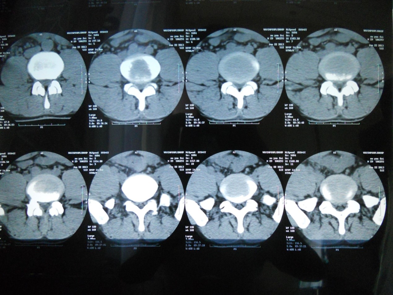 CT、X光、核磁共振，谁更适合腰突症检查，你都了解吗？