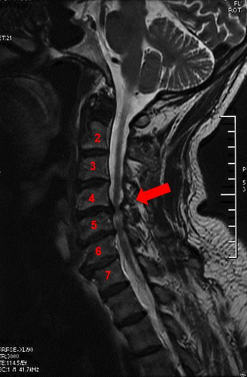 颈椎间孔分离试验图片