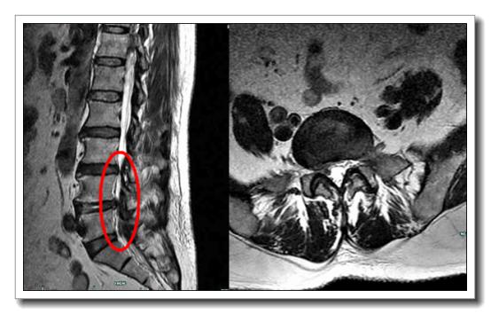 病例:椎間孔鏡技術治癒腰4/5,腰5/骶1椎間盤突出症