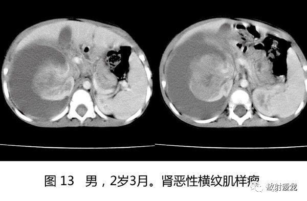 (4)腎透明細胞肉瘤好發於3～5歲,瘤體較大,鈣化多見,呈散在斑點狀或斑