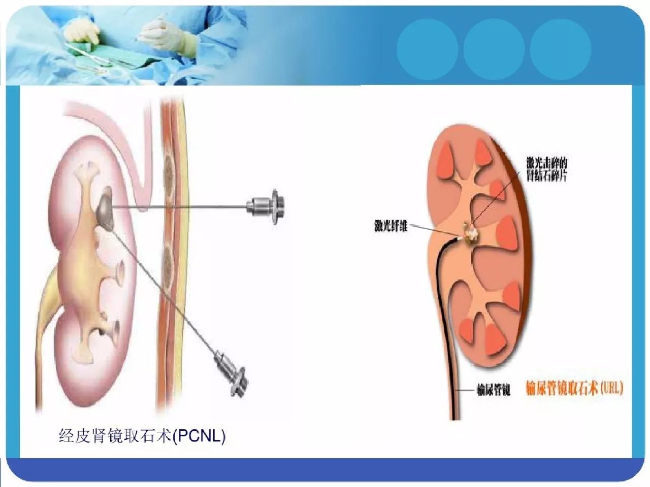 经皮肾镜碎石取石术后护理查房