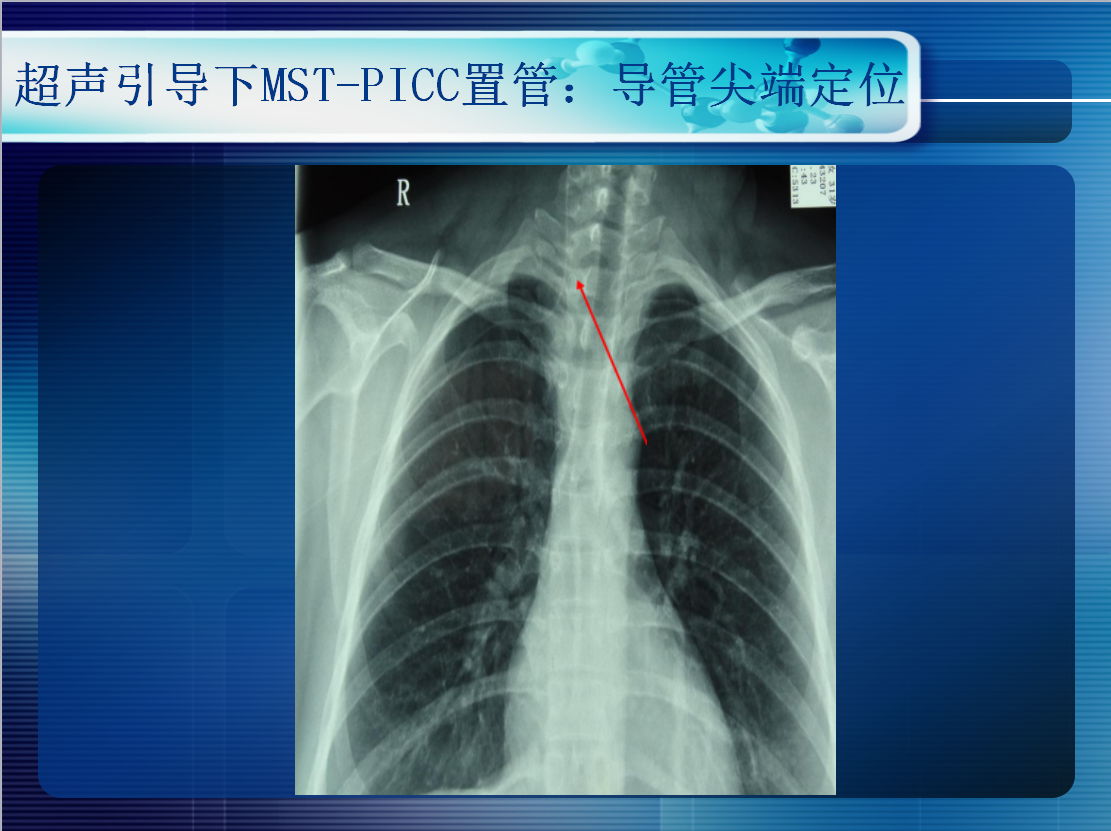 米老鼠征超声图片图片