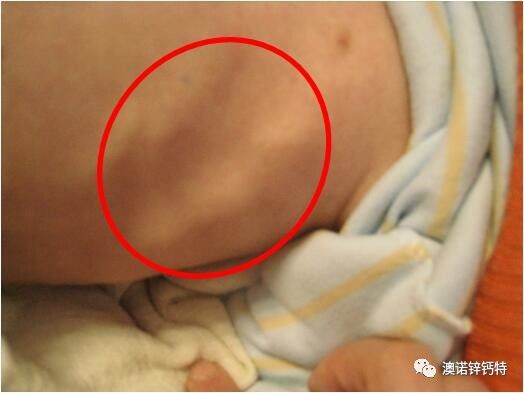 婴儿肋骨串珠的图片图片