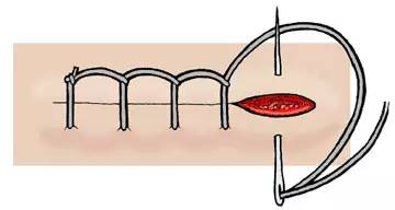 (3)連續鎖邊縫合法(continuous lockstitch suture/ blanket stitch)