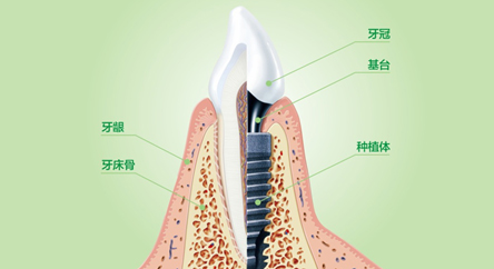 种植牙三期图解 步骤图片