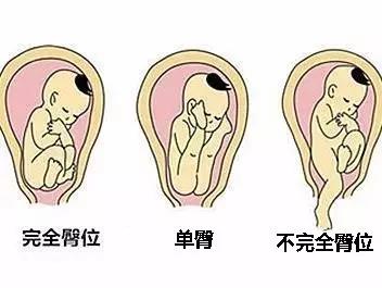 右骶后位胎儿图片图片