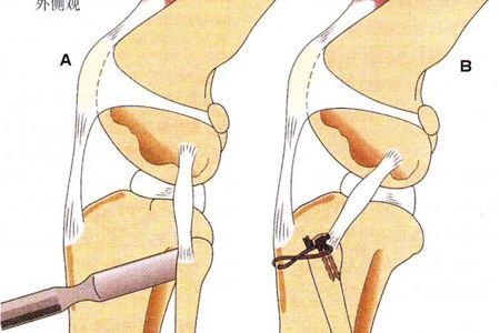 髌韧带断裂手术图解图片