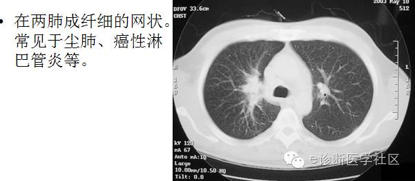 这种改变可局限于肺门附近,也可以扩展到肺野外带,肺纹理增多增强,呈