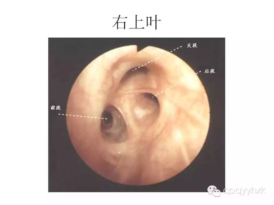 【乾貨】氣管鏡圖譜