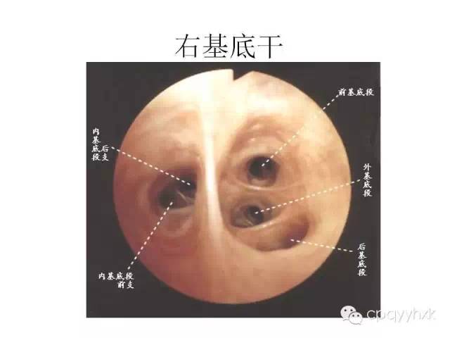 支气管镜入门图谱图片