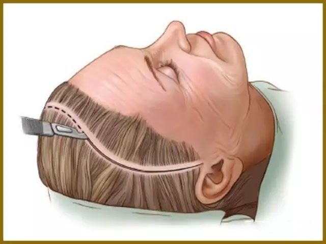 (上)颞侧眉提升术切口位置,该切口可与内镜切口或全面除皱术切口