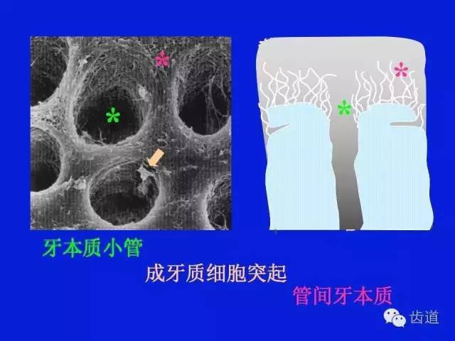 主要步骤处理剂(conditioner)去除玷污层,管塞脱矿胶原纤维网eliades