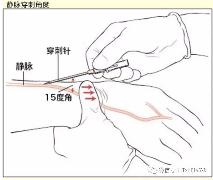 手指麻醉注射的部位图片