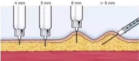 同是皮下注射:為何胰島素筆可垂直進針,而醋酸戈舍瑞林就不行