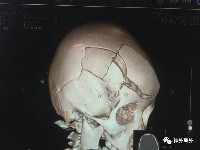 脑外伤后颅骨粉碎性骨折复位,脑血肿清除,垂体瘤切除等手术先后完成