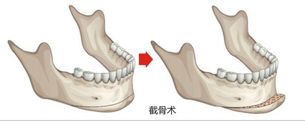 做磨骨瘦脸的手术