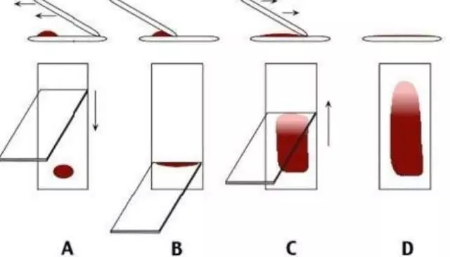 血涂片的制作步骤图谱图片