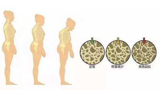 1億人存在低骨量問題,有近7000萬骨質疏鬆患者.