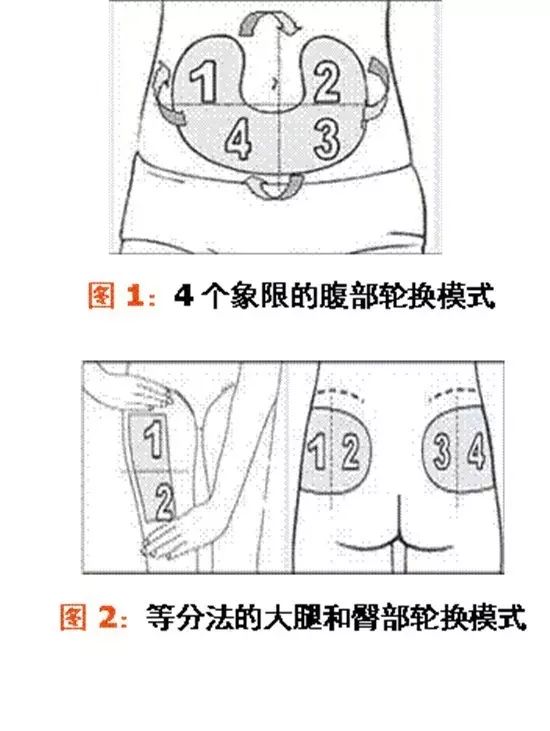 脐周注射的位置标准图图片