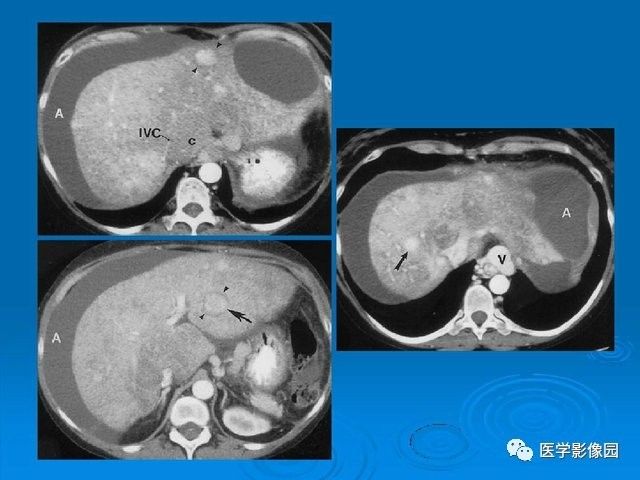 肝臟少見病變和徵象ct讀片丨影像天地