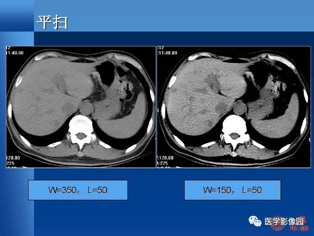 肝轉移癌ct檢查流程設計與優化探討學習丨影像天地