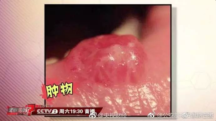 别再大意了口腔溃疡经久不愈后果很严重或致口腔癌