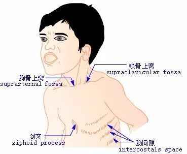 发烧,并表现安静时呼吸频率增快但无明显胸凹陷就可诊断为轻度肺炎;如